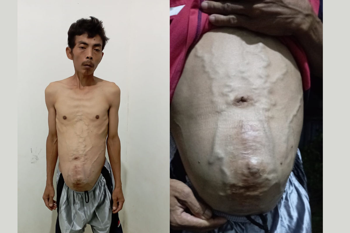 Miris! Wawan Caswan Penderita Tumor dari Kuningan Butuh Uluran Tangan